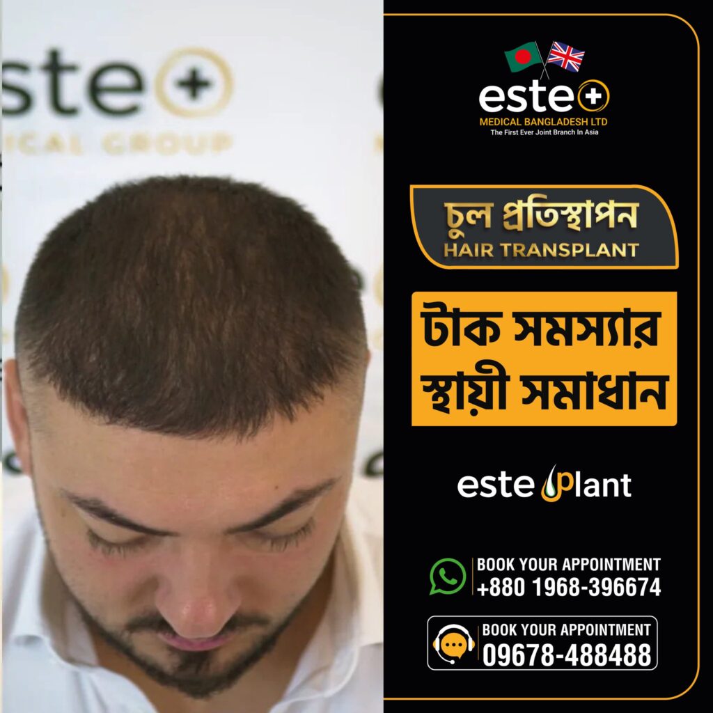 Este Medical_Hair Implant